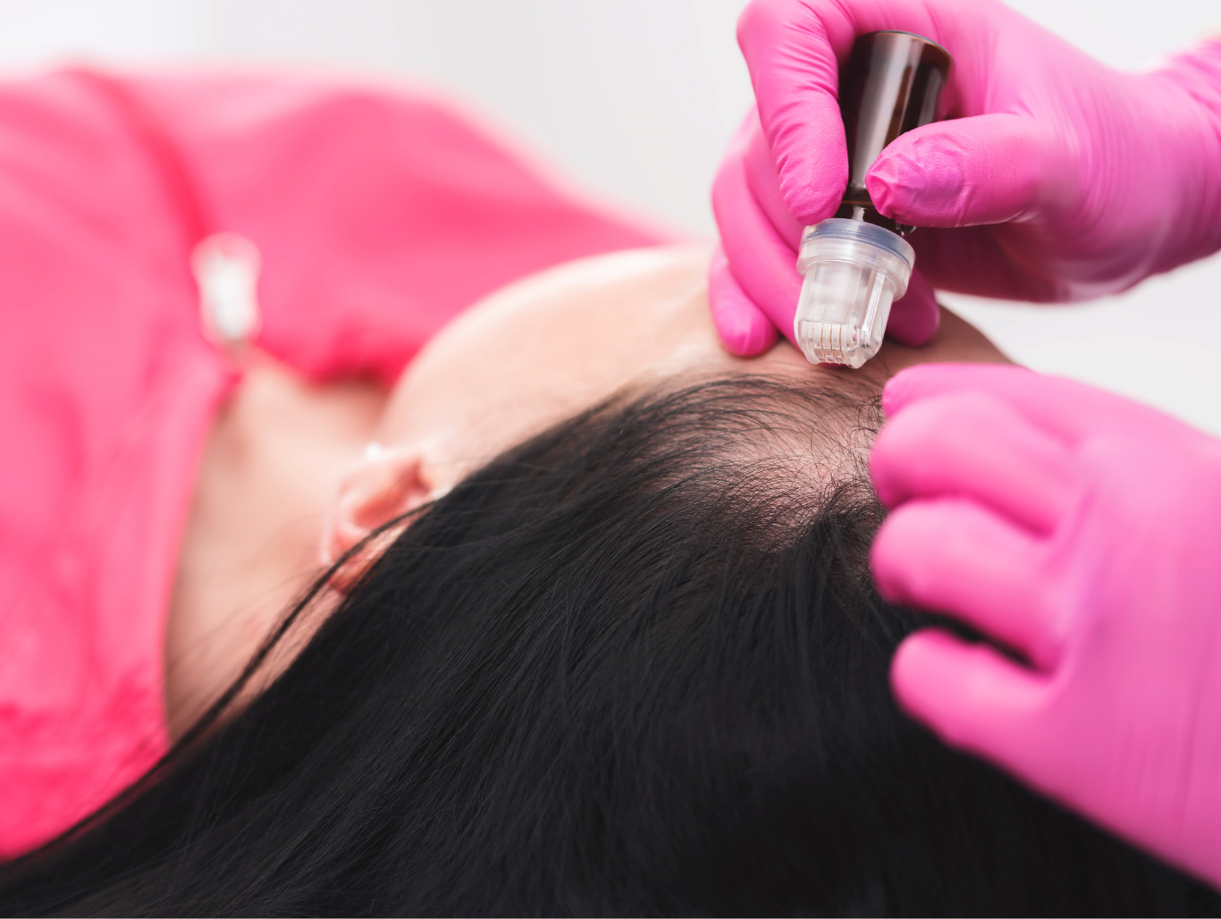 scalp-dermabrasion-treatment-hair-health-weymouth.png